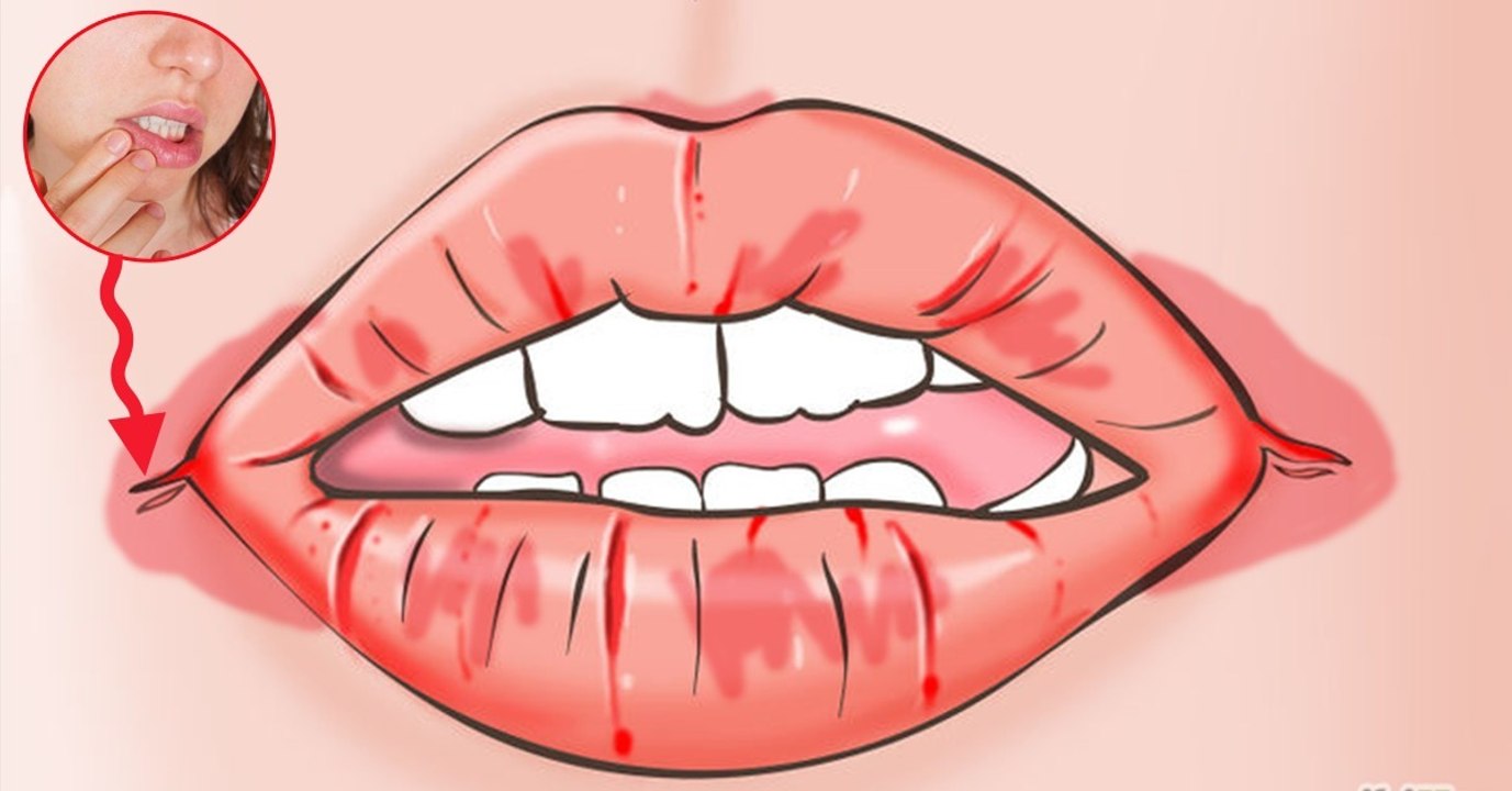 Santé : les astuces pour camoufler les perlèches aux coins de la bouche pendant l'hiver