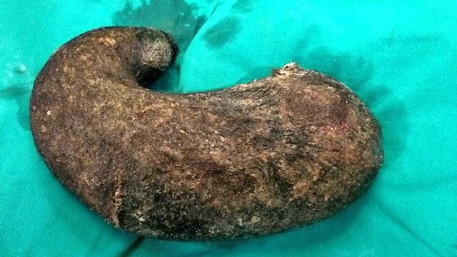 Syndrome de Raiponce : les médecins retrouvent une immense boule de cheveux dans le ventre de cette trichotillomane
