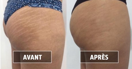 Rodolpho Torres Tatuador : ce tatoueur brésilien camoufle les vergetures des femmes avec de l'encre !