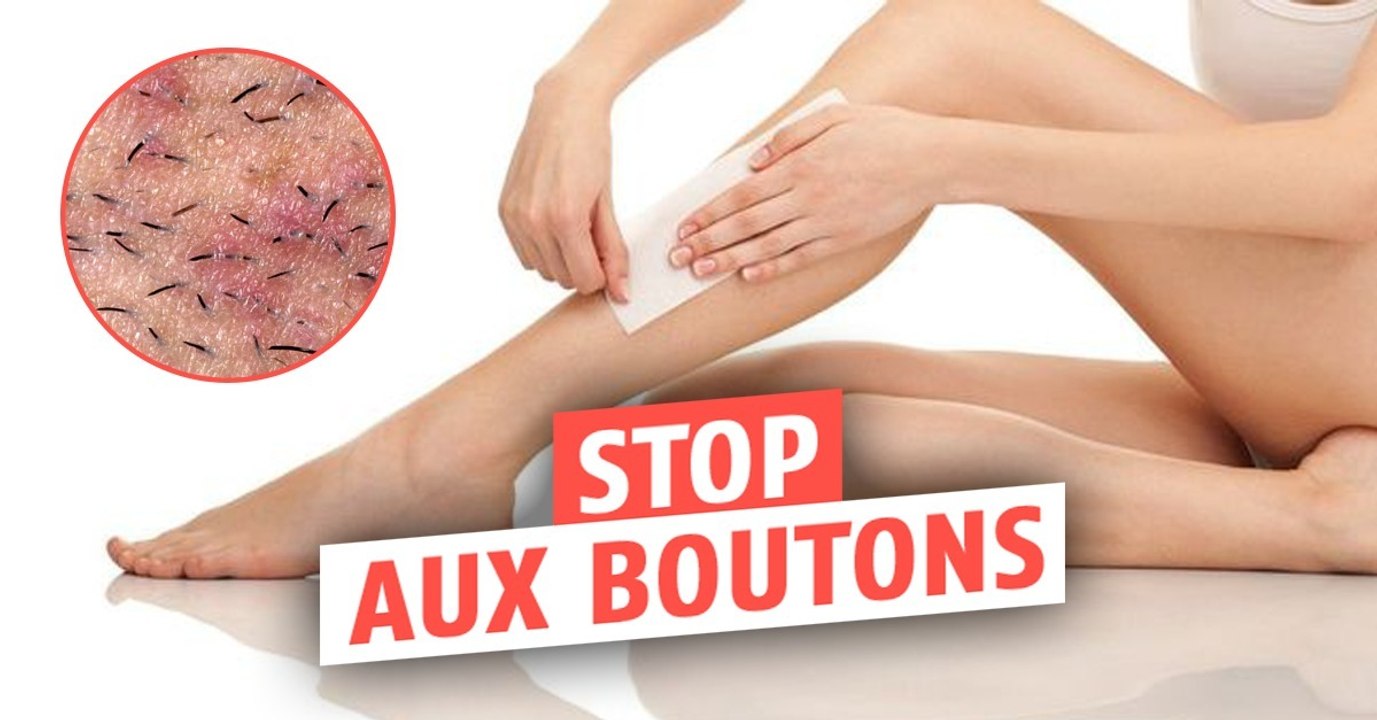 Epilation : comment éviter et se débarrasser des petits boutons après une épilation à la cire