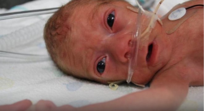 Ce petit bébé est né au bout de 27 semaines de grossesse seulement... 4 ans plus tard, voilà à quoi il ressemble !