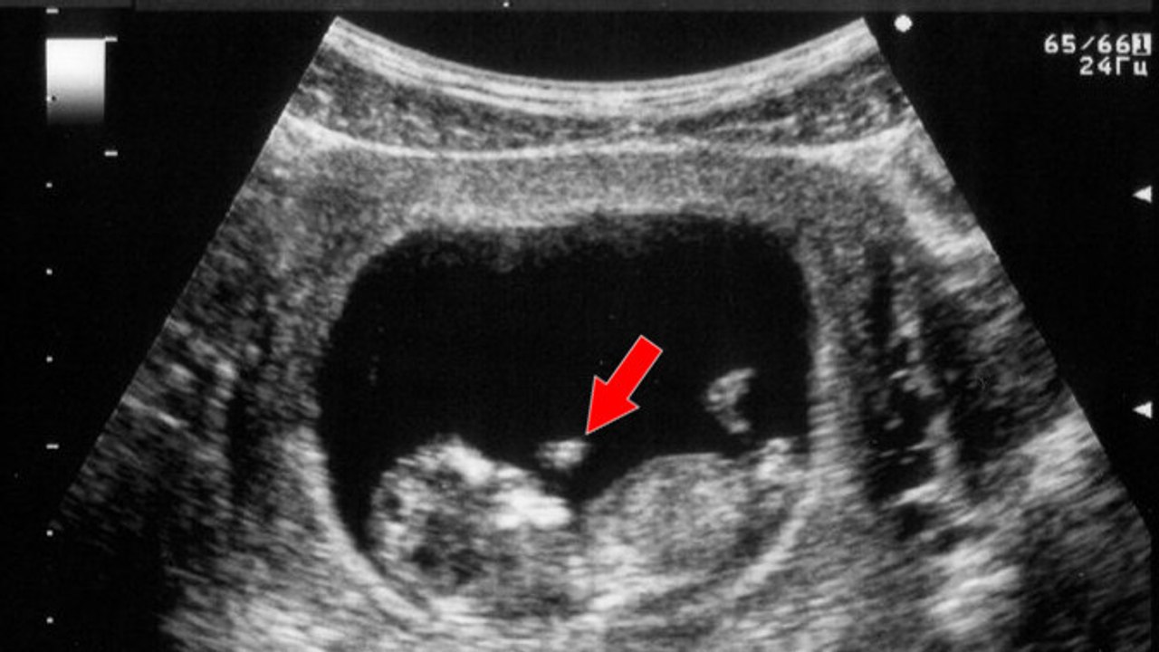 Grossesse : prématuré, elle retient son enfant dans son ventre pendant 39 jours