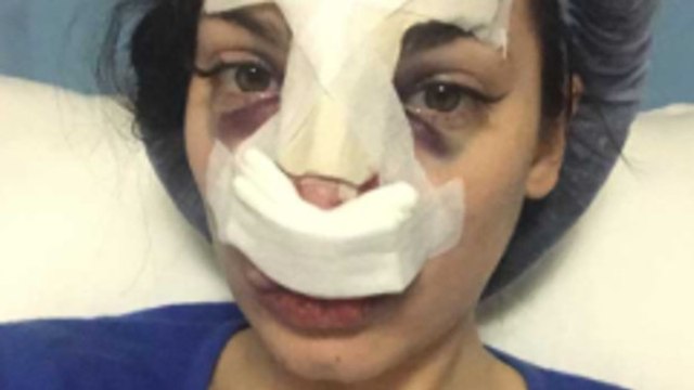 Nadège Lacroix : elle poste les photos choc de sa chirurgie esthétique