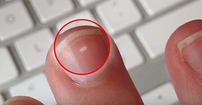 Santé : si vous avez ces petites tâches blanches sur vos ongles, voici la raison