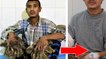Abul Bajandar : après seize opérations, l'homme arbre atteint d'épidermodysplasie verruciforme est transformé !