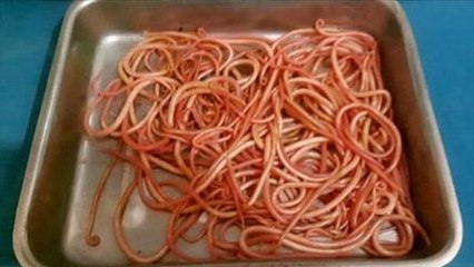 Santé : cette jeune femme avait d'horribles douleurs à l'abdomen à cause de vers