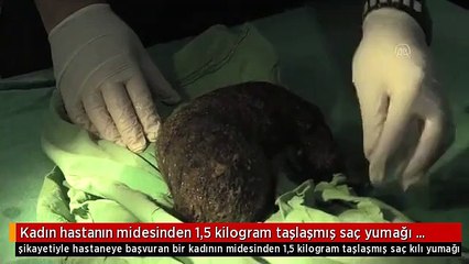 Siirt'te kadın hastanın midesinden 1,5 kilogram taşlaşmış saç yumağı çıktı