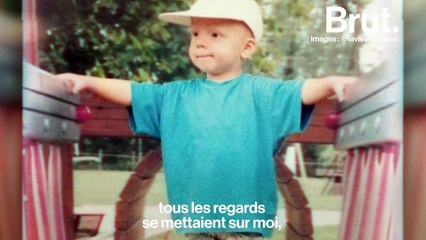 La vie en chauve : David veut faire connaître l'alopécie, sa maladie