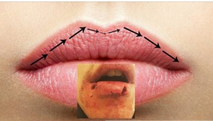 La réduction des lèvres : l'incroyable nouvelle tendance de chirurgie esthétique Thaïlandaise