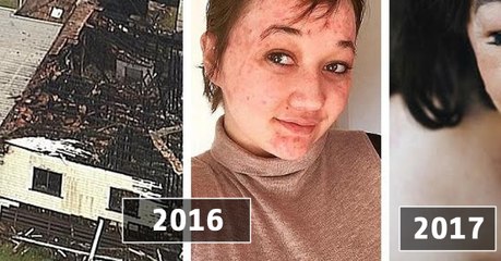 Brianna Creenaune : elle réalise un photoshoot après 50 opérations pour réparer sa peau brulée