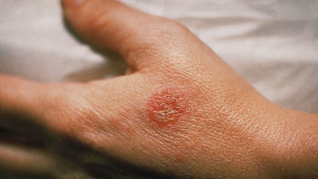 Eczéma : causes, traitement et symptômes de la maladie