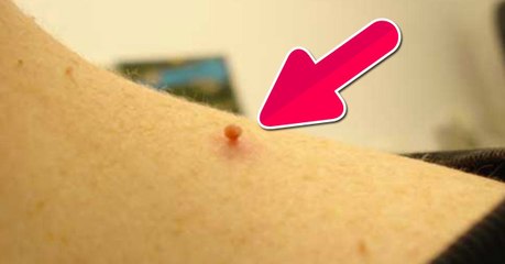 Acrochordons : comment s'en débarrasser naturellement