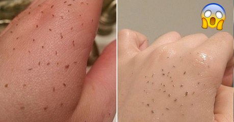 Sur Reddit, ce nouveau soin maison anti-points noirs rend fou le web