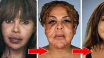 Cette femme transgenre se fait injecter du ciment dans le visage. 10 ans plus tard, les docteurs lui viennent en aide