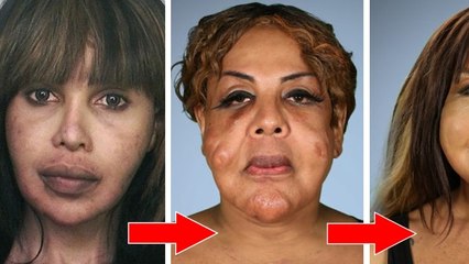 Cette femme transgenre se fait injecter du ciment dans le visage. 10 ans plus tard, les docteurs lui viennent en aide