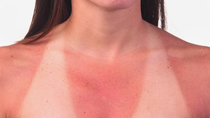 Canicule : coups de soleil, quand faut-il s'inquiéter ?