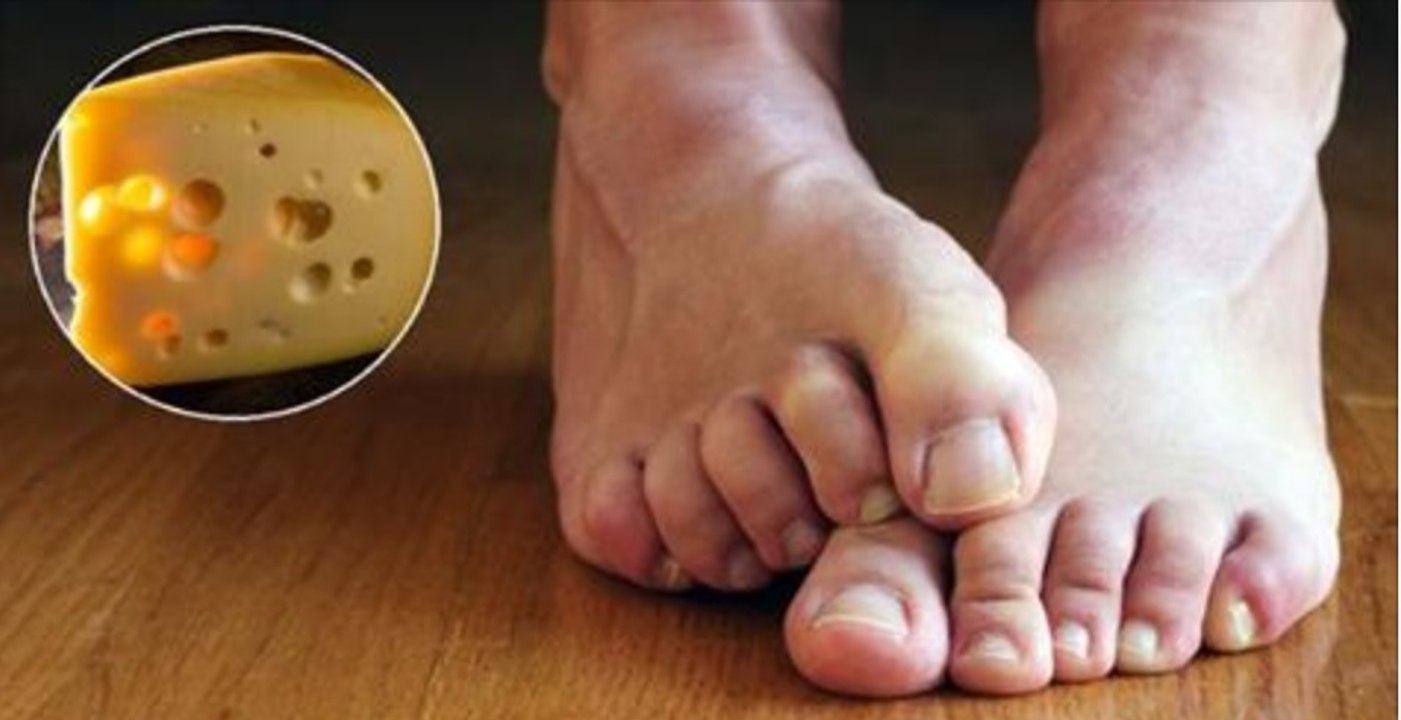 Pourquoi les pieds sentent-ils parfois le fromage ?