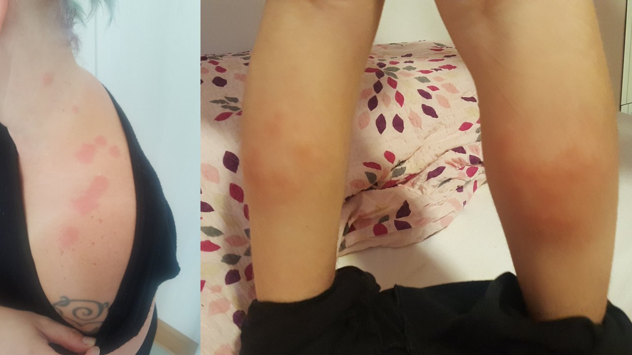 Elle regarde la jambe de sa fille et découvre le pire cauchemar de tout voyageur