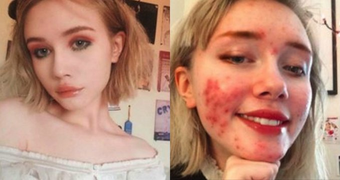 Quand poser fièrement avec son acné devient viral sur Instagram