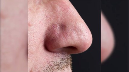 Il a le nez bouché pendant presque 50 ans à cause d'un objet étonnant