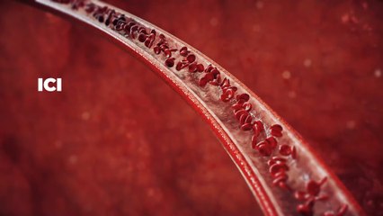 Artères bouchées, voici les symptômes à ne pas négliger