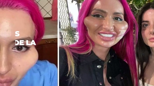 Chirurgie esthétique, accro, elle prétend avoir les plus grosses joues de la terre