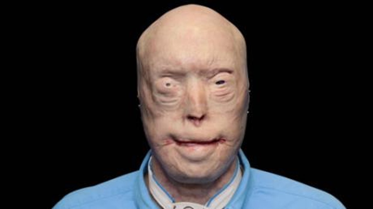 After Losing His Face In A Fire, This Man's Lif...
