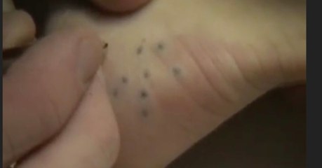 She Got These Weird Marks On Her Foot And He Removed Something Horrible
