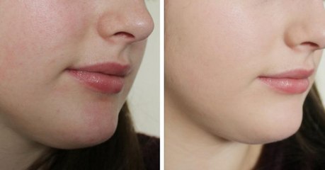 This One Simple Ingredient Will Get Rid Of Blackheads And Leave Your Skin Glowing