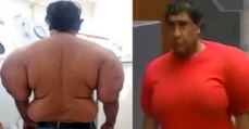 This Man Swelled To Twice His Normal Size After A Terrible Accident