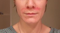 Facial Eczema: Symptoms, Treatments, And Causes