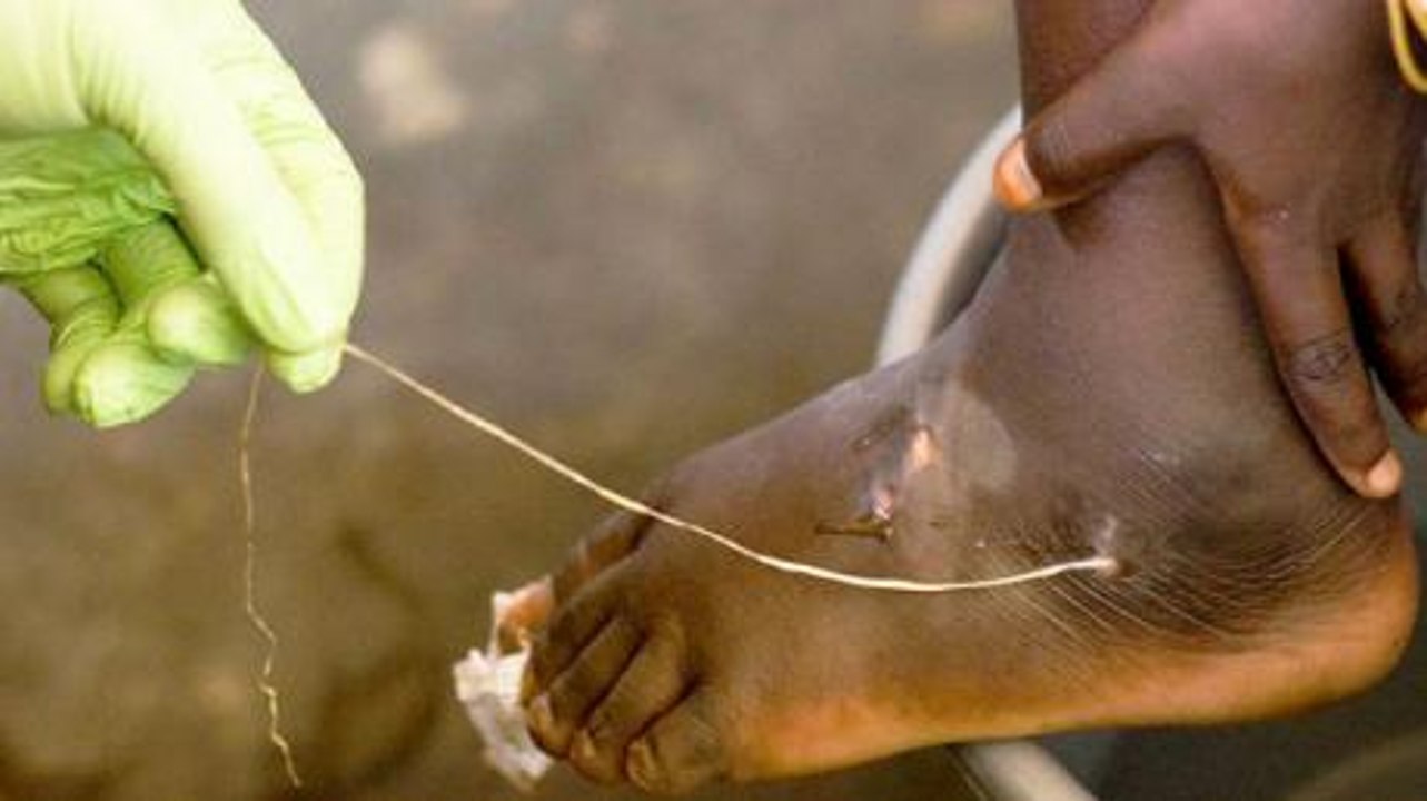 Dracunculiasis: The Terrifying Disease Caused By Parasitic Worms