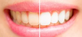 Say Bye Bye To Coffee Stained Teeth For Good