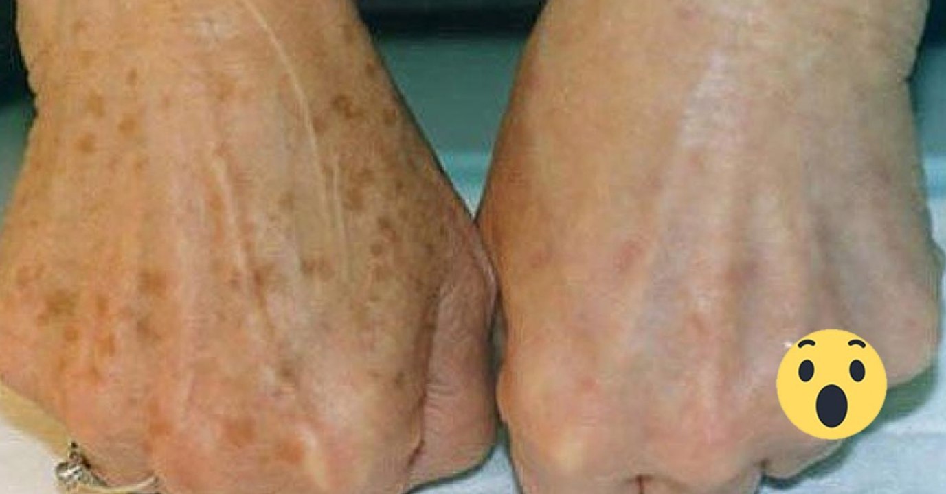 These Two Natural Ingredients Are All You Need To Get Rid Of Age Spots