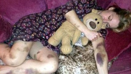 She Woke Up After A Night Out Covered In Bruises - But The Truth Behind Them Was Devastating