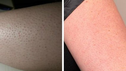 We Finally Know Where These Little Red Spots Come From