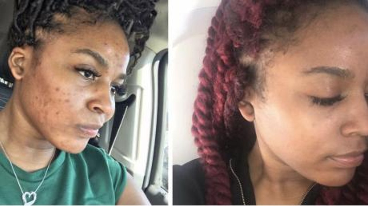 People Have Been Posting Shocking Before-And-After Pics Thanks To This 60-Second Miracle Skincare Trick