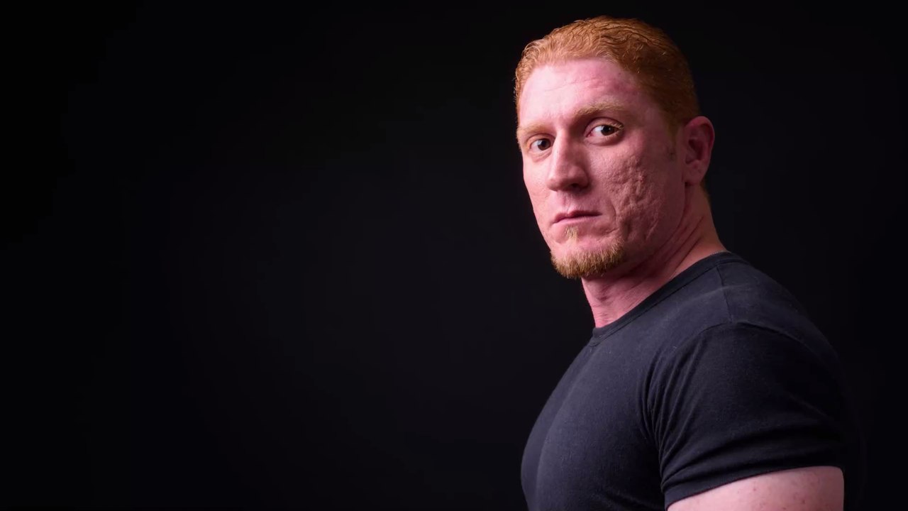 This is how to minimize the appearance of acne related scarring