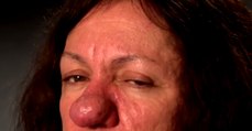 At The Age Of 15, This Woman's Nose Started To Grow Uncontrollably (COMPLAINT)