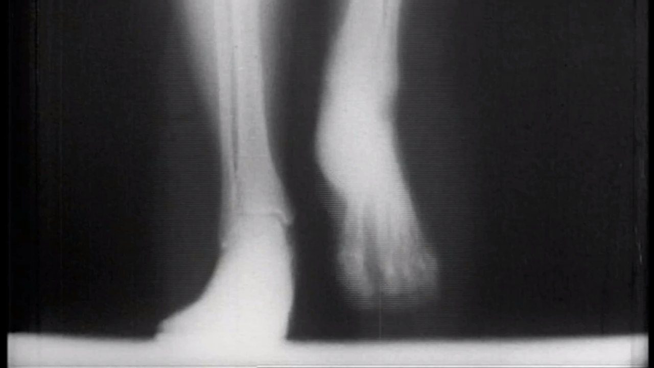 Indian doctor identifies 'bone death' as long COVID complication