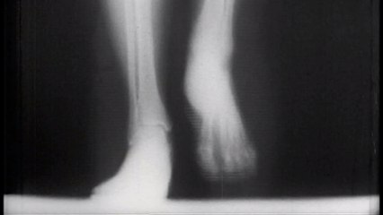 Indian doctor identifies 'bone death' as long COVID complication