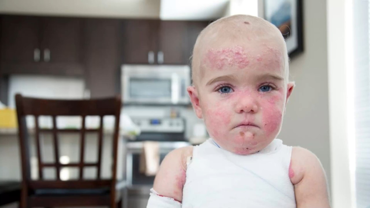 They are called 'butterfly children' and they struggle with a terrible illness