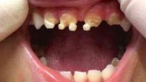 Child's Teeth Destroyed And Here's The Shocking Reason Why