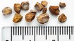 Doctors remove 156 kidney stones from man’s stomach