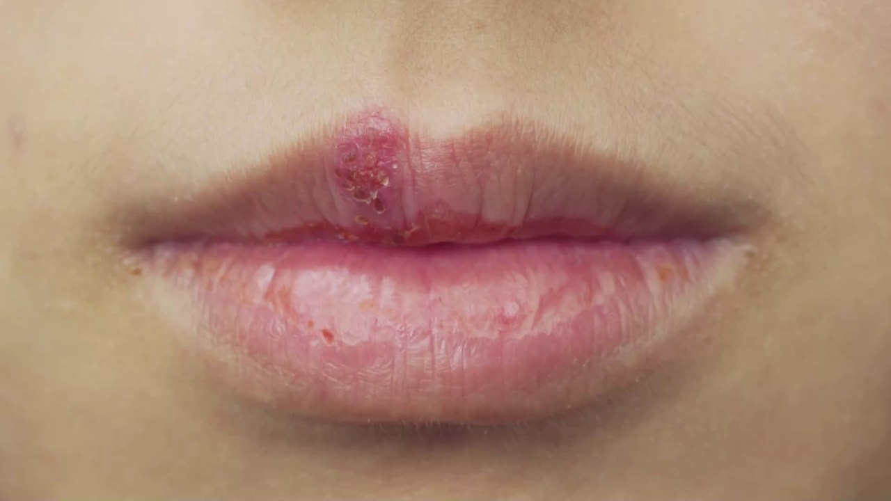Decoding herpes: Telltale sign that you've been infected