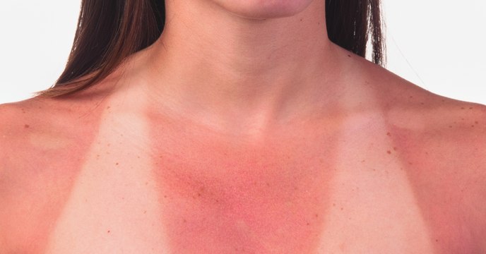 This Is The Real Reason That Sunburn Turns Your Skin Red