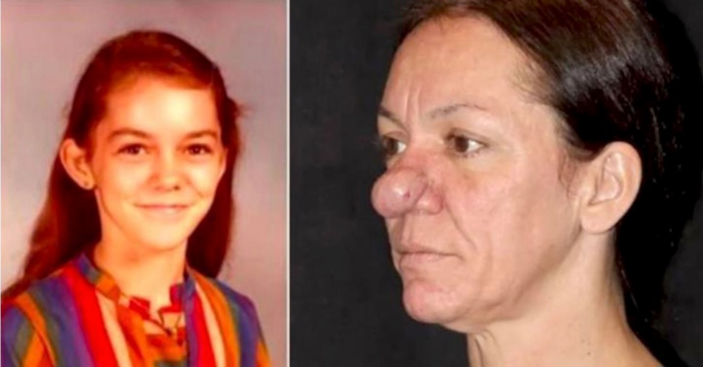 This Woman's Nose Has Been Growing Since She Was 15 Years Old, Find Out What She Looks Like Now!