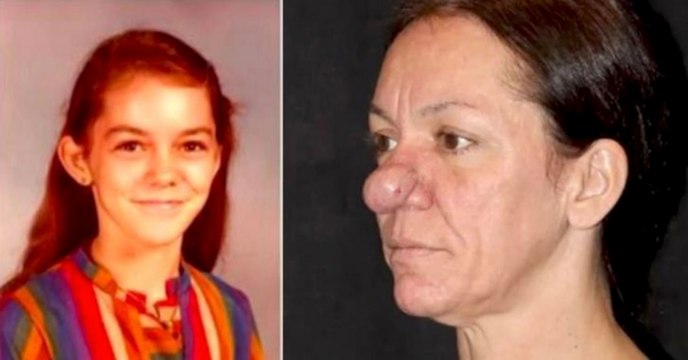 This Woman's Nose Has Been Growing Since She Was 15 Years Old, Find Out What She Looks Like Now!