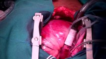 Surgeons use cocaine in heart transplant