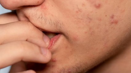 Cystic acne: What it is and how to treat it